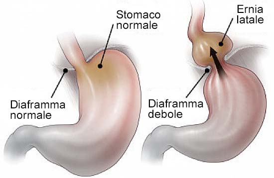 Ernia jatale: quali sono i sintomi?