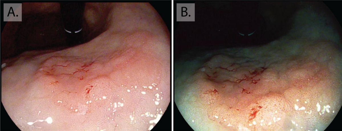 Tumori gastrici allo stadio iniziale (early gastric cancer)