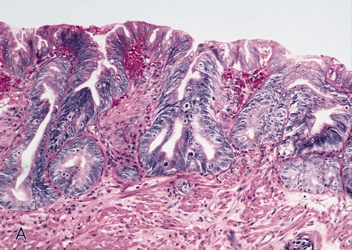 Tumori esofagei allo stadio iniziale (early esophageal cancer)