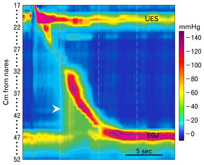 Outflow obstruction: facciamo un po' di chiarezza!