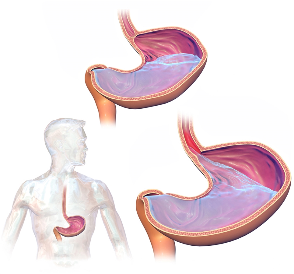 Malattia da reflusso gastroesofageo