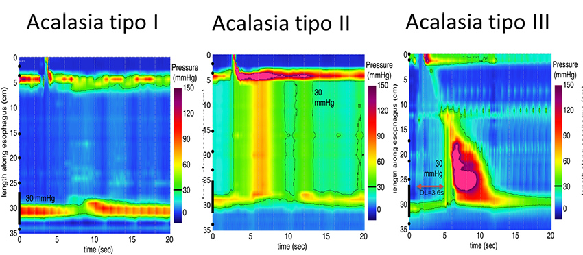 Acalasia di tipo 1: intervento sec. Heller-Dor