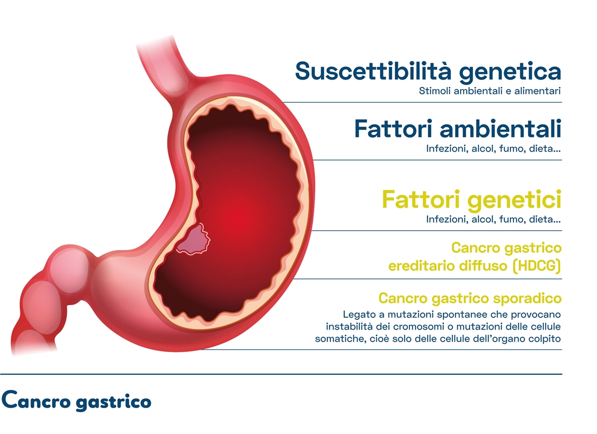 Cancro gastrico diffuso ereditario