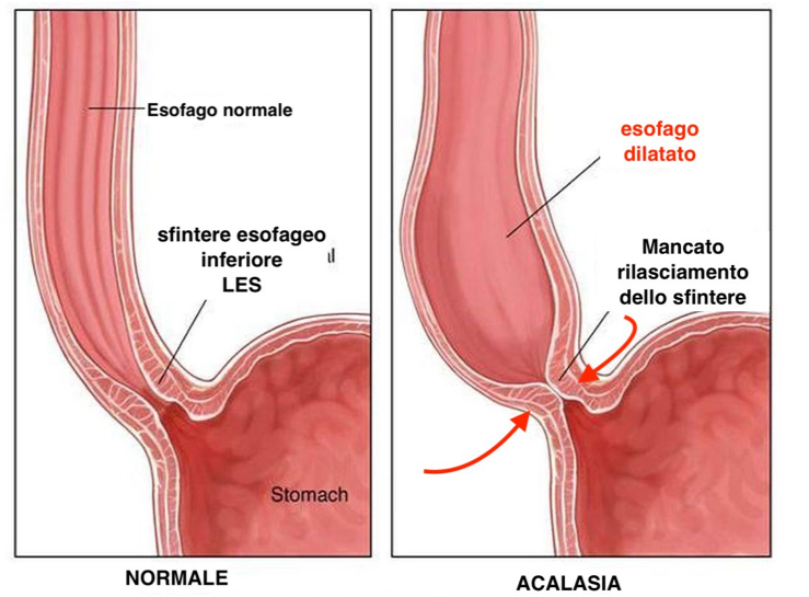 Acalasia, analisi delle opzioni di trattamento